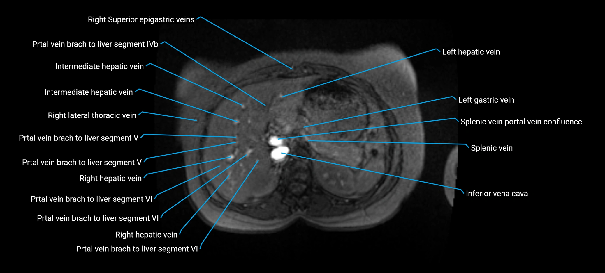 MRV abdomen pelvis & lower limb axial cross sectional anatomy labelled MRI image 46 (1).webp